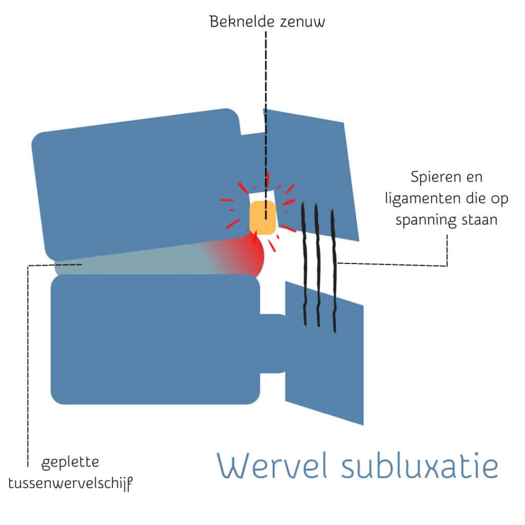 trc afbeelding blog wervel subluxatie